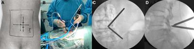 Clinical comparison of percutaneous transforaminal endoscopic discectomy and unilateral biportal endoscopic discectomy for single-level lumbar disc herniation